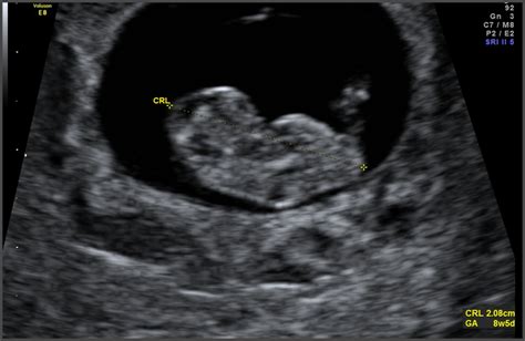 how accurate is a dating scan at 5 weeks